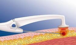 The BodyTite™ cannula tightens and aspirates fat: Thanks to the heat of the radio waves, the connective tissue contracts while excess fat simultaneously becomes liquefied and is immediately aspirated. The BodyTite™ cannula tightens and aspirates fat: Thanks to the heat of the radio waves, the connective tissue contracts while excess fat simultaneously becomes liquefied and is immediately aspirated.